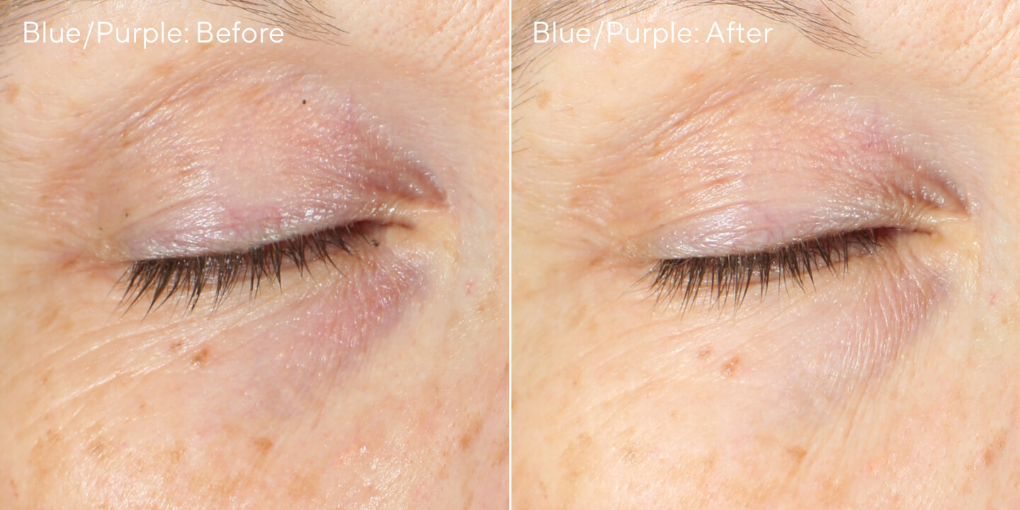 9770-before-after_eye-blue-purple